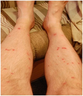 Marks on skin caused by bedbug bites
